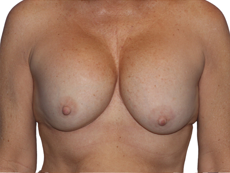 Breast Revisions Before and After | PERK Plastic Surgery