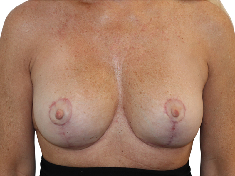 Breast Revisions Before and After | PERK Plastic Surgery