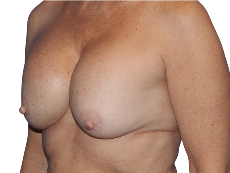 Breast Revisions Before and After | PERK Plastic Surgery