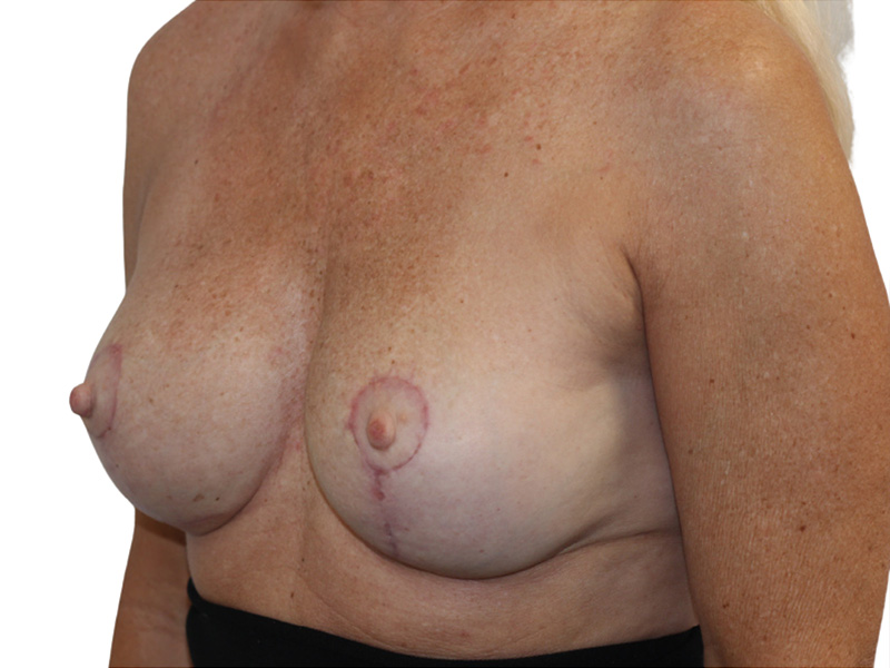 Breast Revisions Before and After | PERK Plastic Surgery