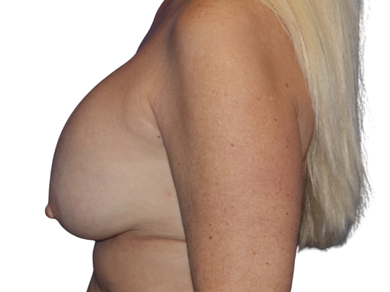 Breast Revisions Before and After | PERK Plastic Surgery