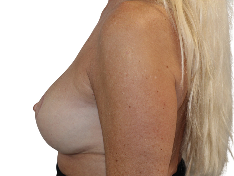 Breast Revisions Before and After | PERK Plastic Surgery