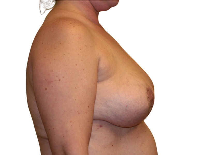 Breast Revisions Before and After | PERK Plastic Surgery