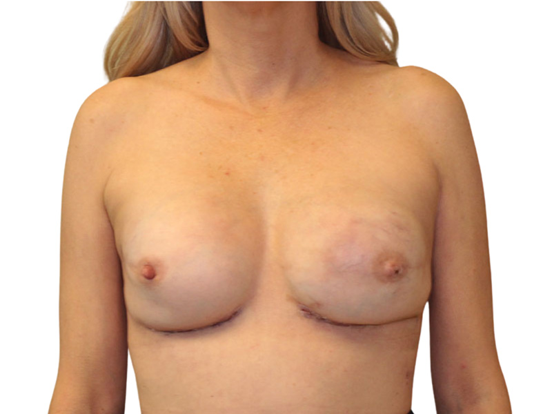 Breast Revisions Before and After | PERK Plastic Surgery