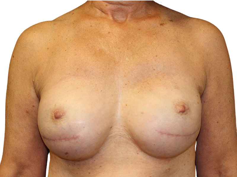 Breast Revisions Before and After | PERK Plastic Surgery