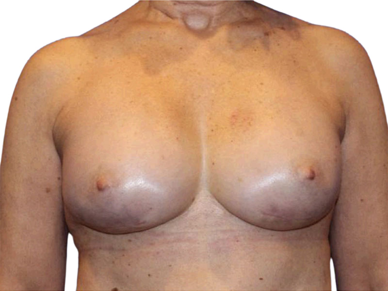 Breast Revisions Before and After | PERK Plastic Surgery