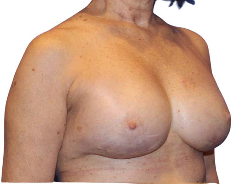 Breast Revisions Before and After | PERK Plastic Surgery