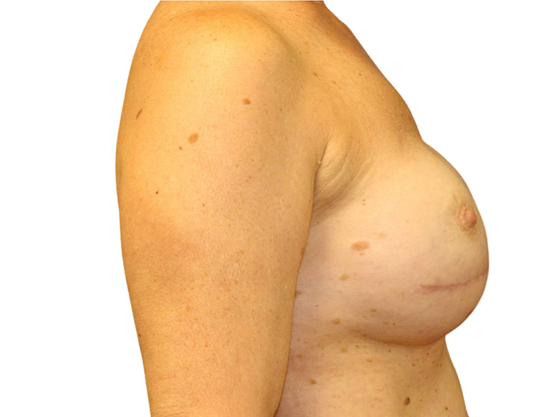 Breast Revisions Before and After | PERK Plastic Surgery