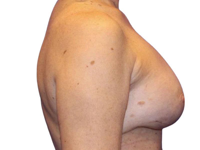 Breast Revisions Before and After | PERK Plastic Surgery