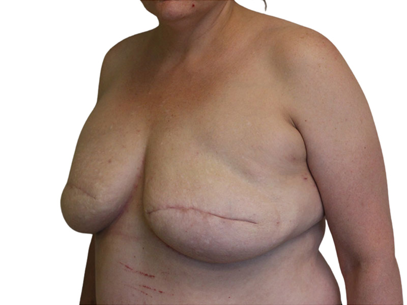 Breast Revisions Before and After | PERK Plastic Surgery