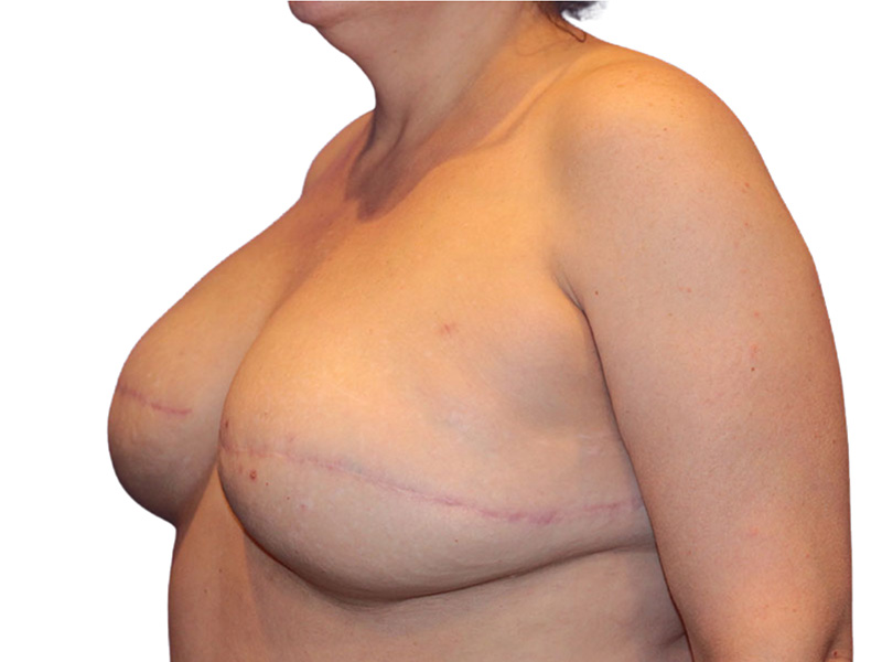 Breast Revisions Before and After | PERK Plastic Surgery
