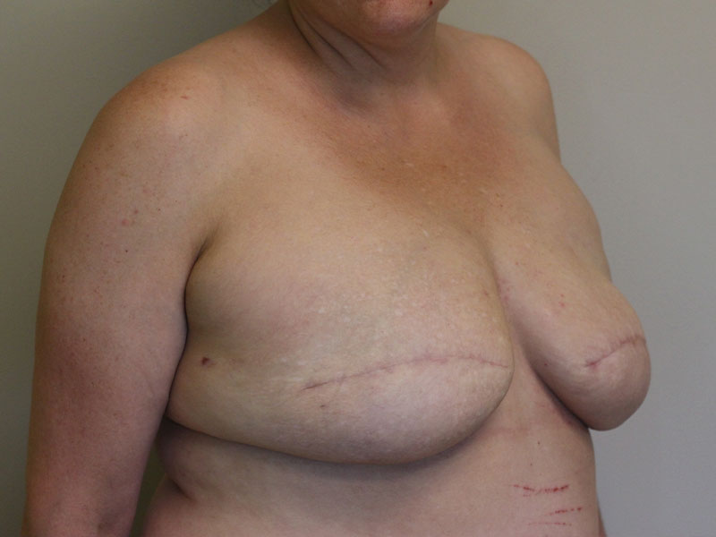 Breast Revisions Before and After | PERK Plastic Surgery