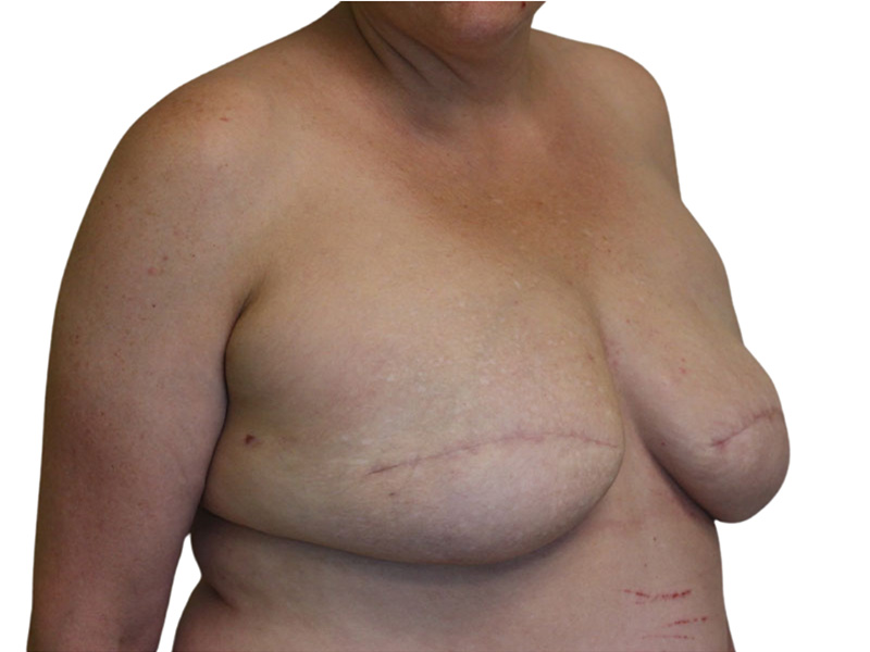 Breast Revisions Before and After | PERK Plastic Surgery
