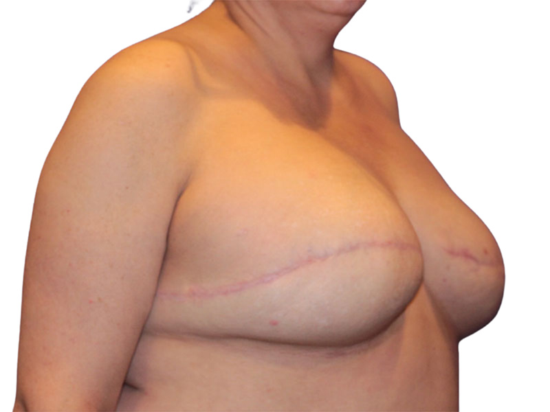 Breast Revisions Before and After | PERK Plastic Surgery