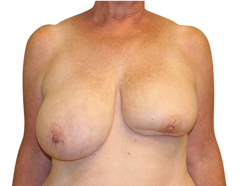 Breast Revisions Before and After | PERK Plastic Surgery