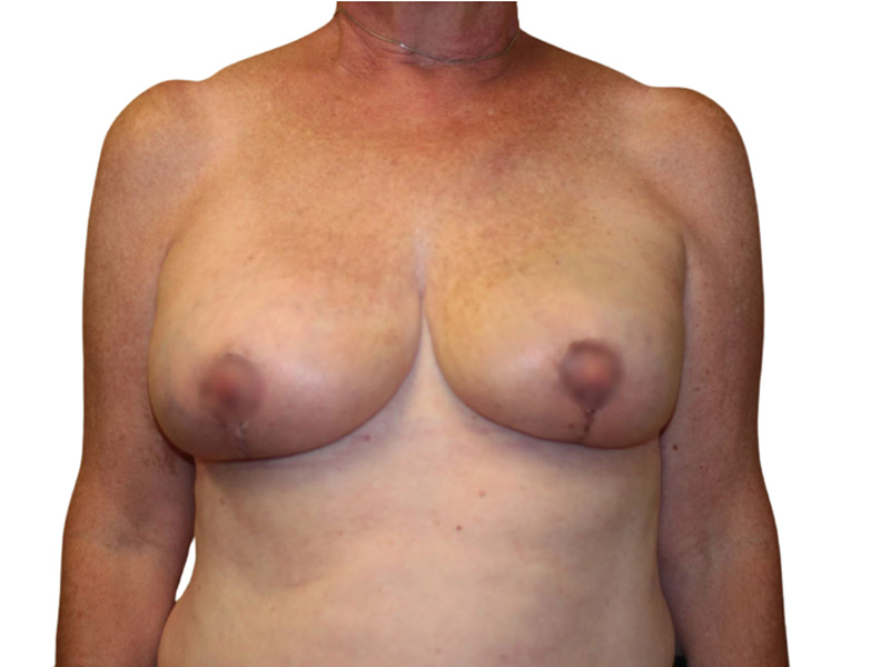 Breast Revisions Before and After | PERK Plastic Surgery