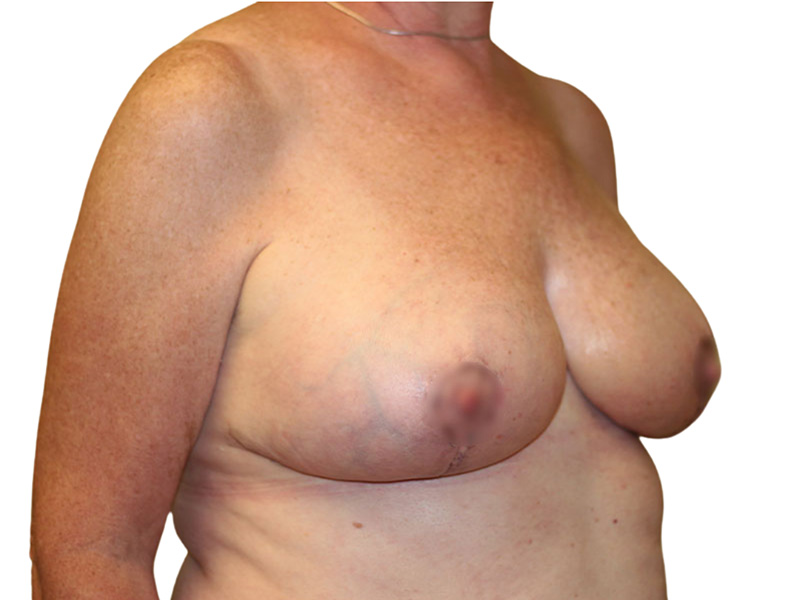 Breast Revisions Before and After | PERK Plastic Surgery