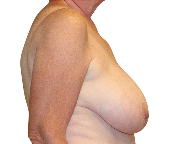 Breast Revisions Before and After | PERK Plastic Surgery