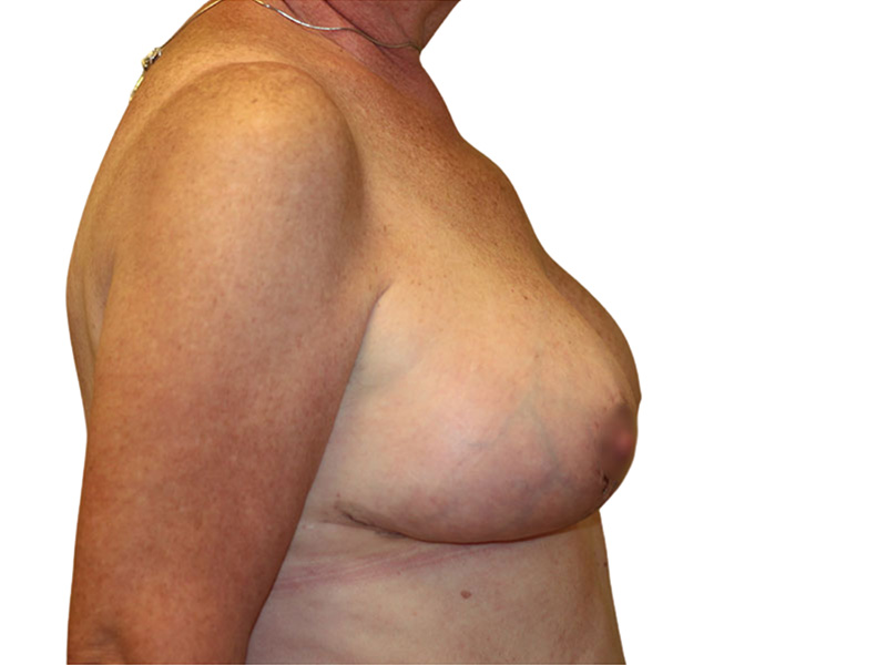 Breast Revisions Before and After | PERK Plastic Surgery