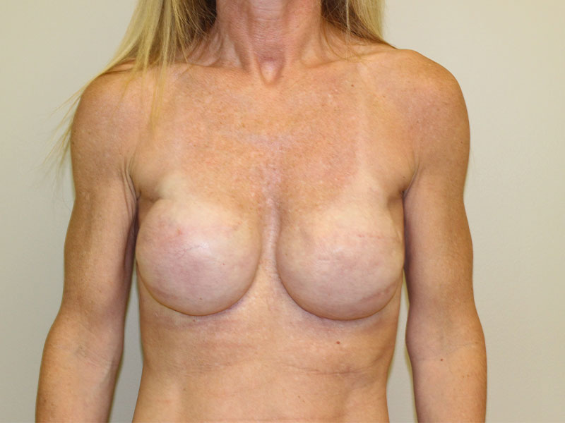 Breast Revisions Before and After | PERK Plastic Surgery