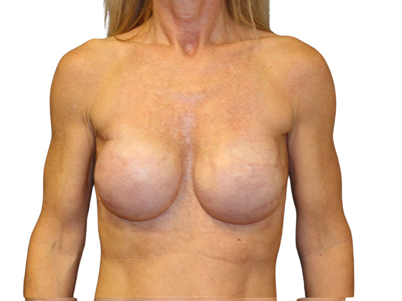 Breast Revisions Before and After | PERK Plastic Surgery