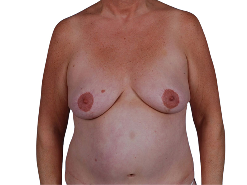 Breast Revisions Before and After | PERK Plastic Surgery
