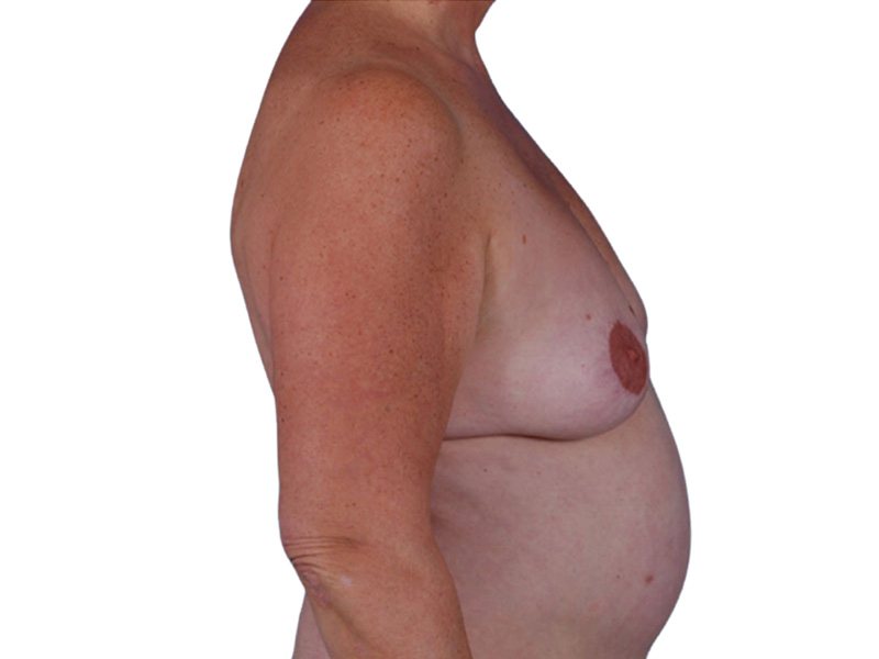 Breast Revisions Before and After | PERK Plastic Surgery