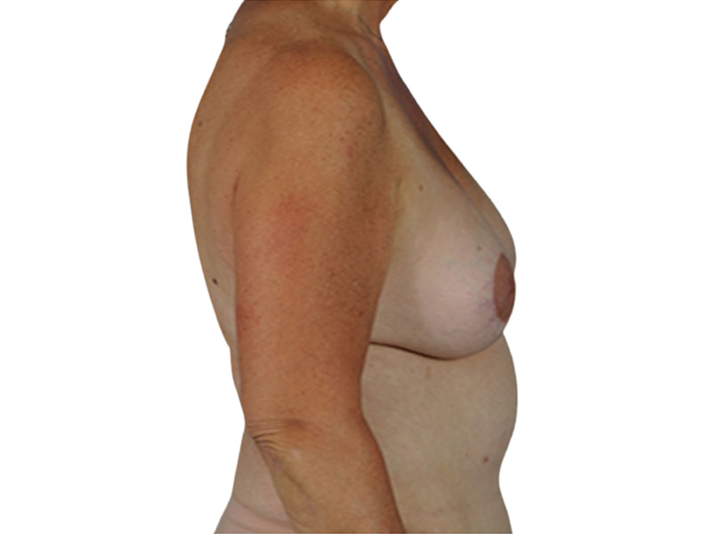 Breast Revisions Before and After | PERK Plastic Surgery