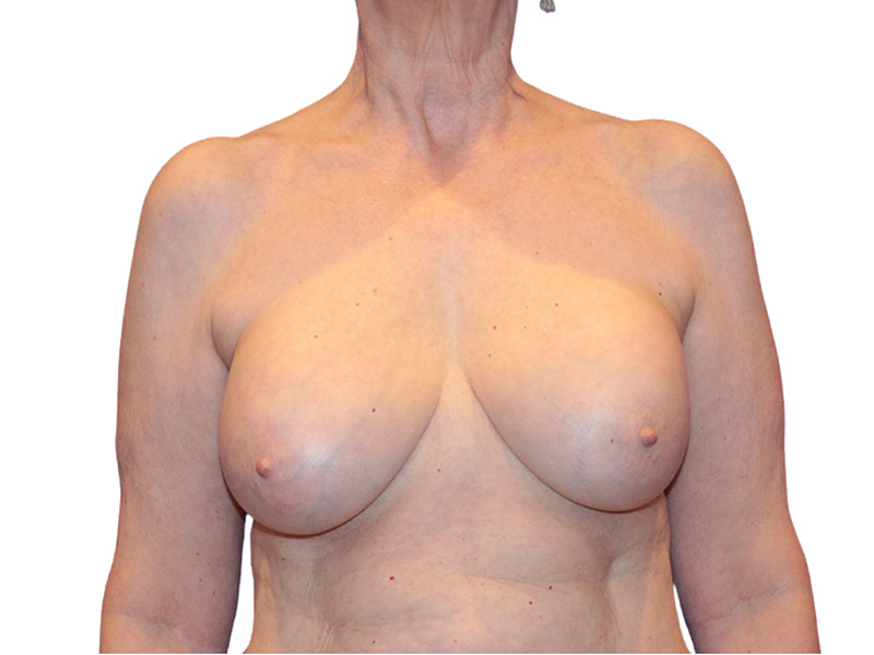 Breast Revisions Before and After | PERK Plastic Surgery
