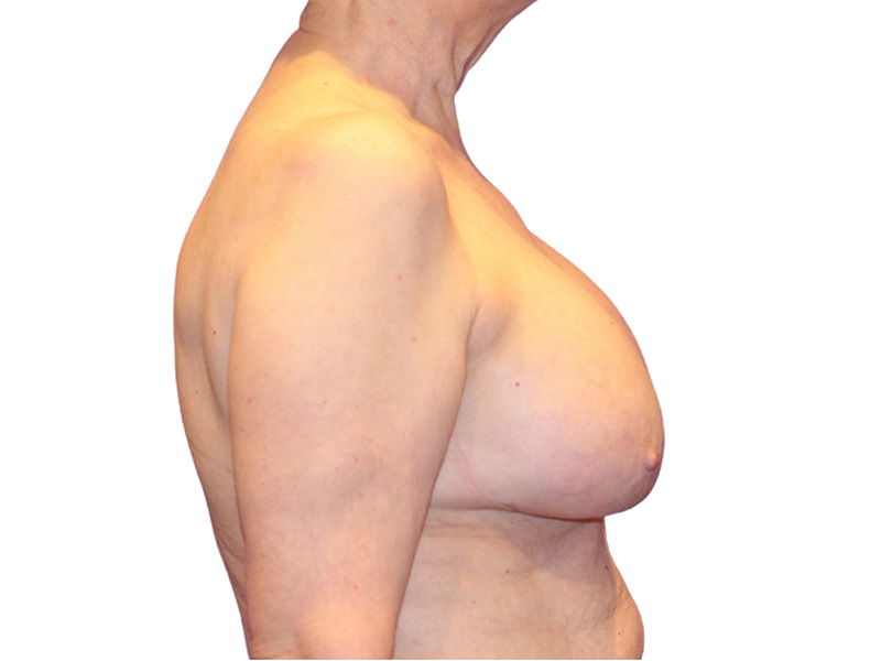 Breast Revisions Before and After | PERK Plastic Surgery