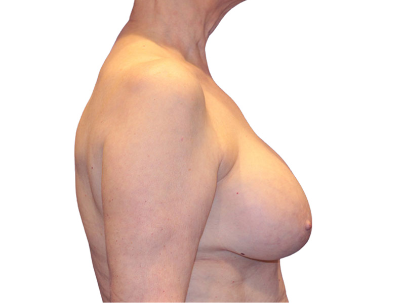 Breast Revisions Before and After | PERK Plastic Surgery