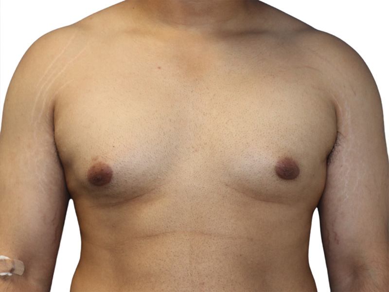 Gynecomastia Beverly Hills