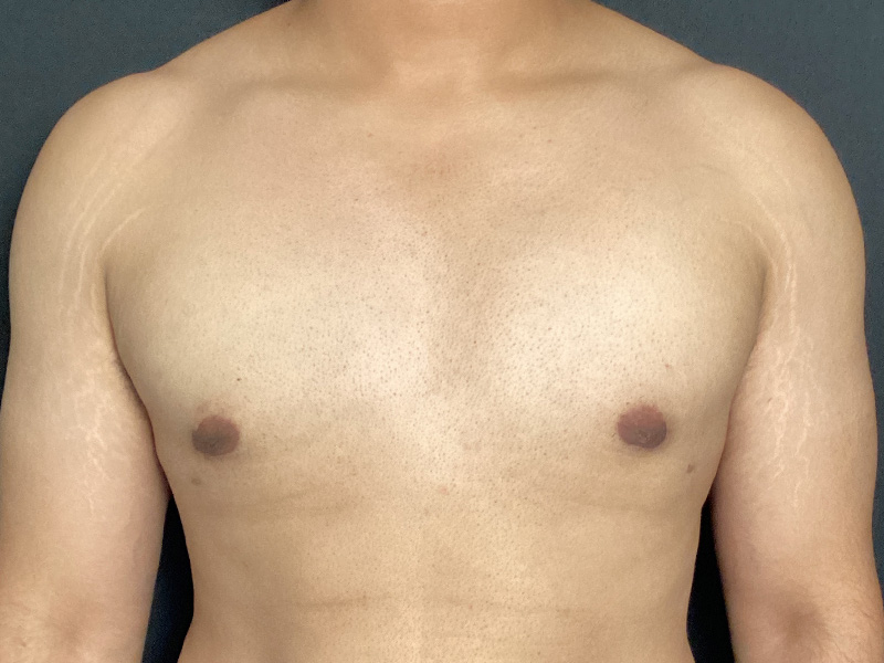 Male Breast Reduction Before and After | PERK Plastic Surgery