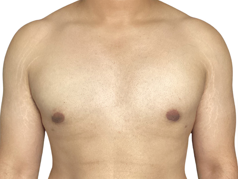 Gynecomastia Beverly Hills