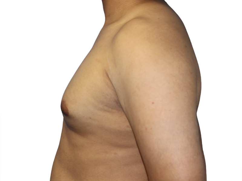 Male Breast Reduction Before and After | PERK Plastic Surgery