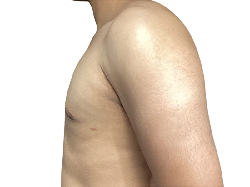 Male Breast Reduction Before and After | PERK Plastic Surgery