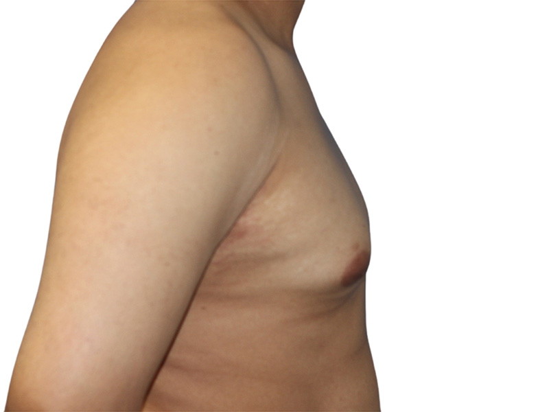 Male Breast Reduction Before and After | PERK Plastic Surgery