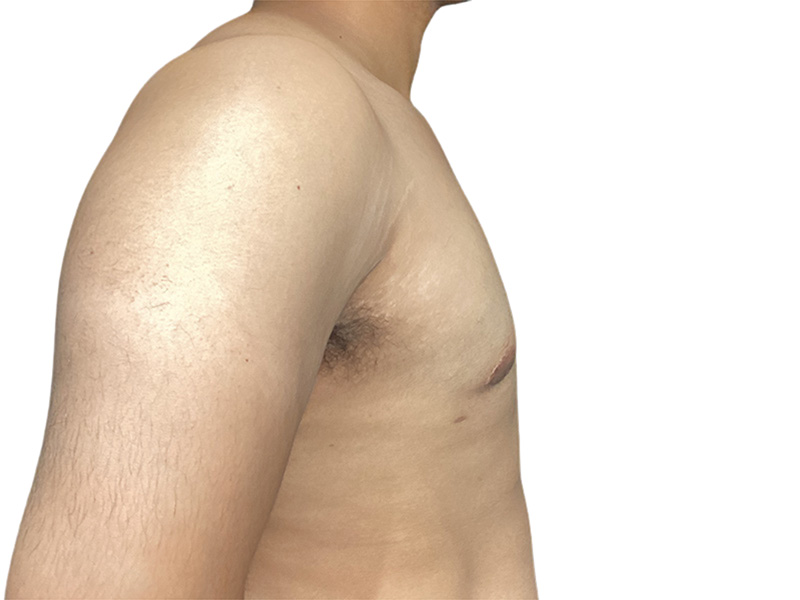 Male Breast Reduction Before and After | PERK Plastic Surgery