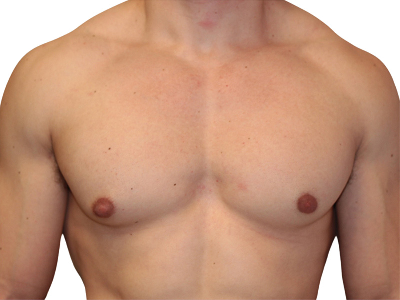 Gynecomastia Beverly Hills