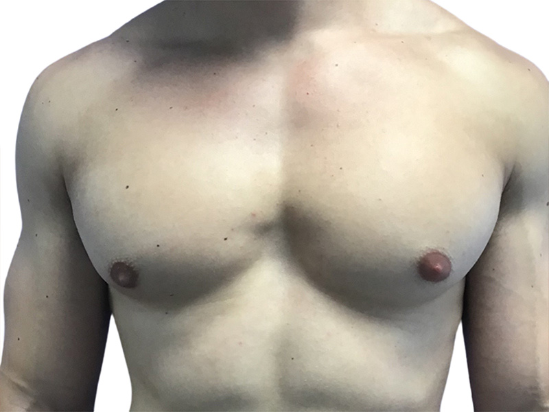 Gynecomastia Beverly Hills