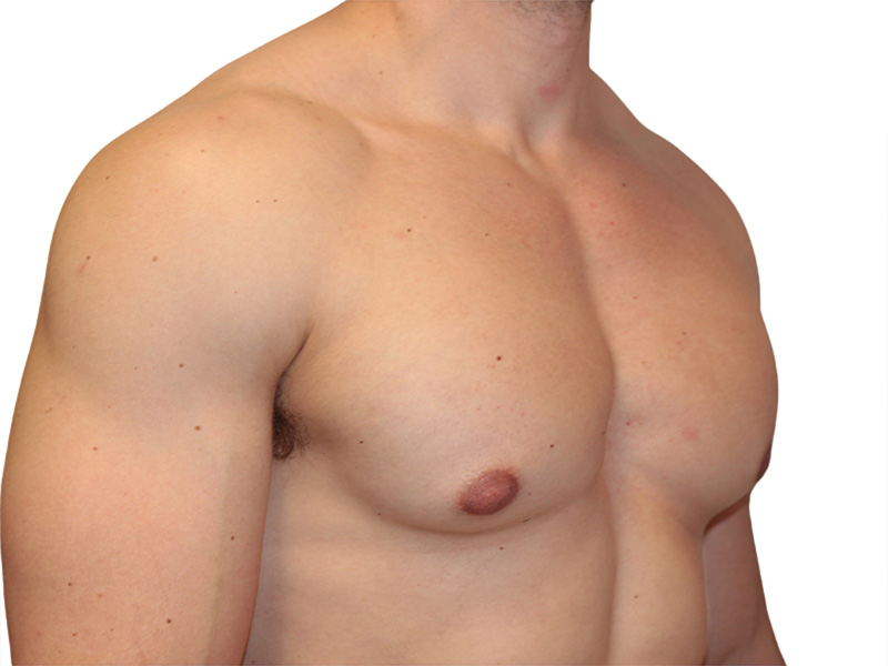 Male Breast Reduction Before and After | PERK Plastic Surgery