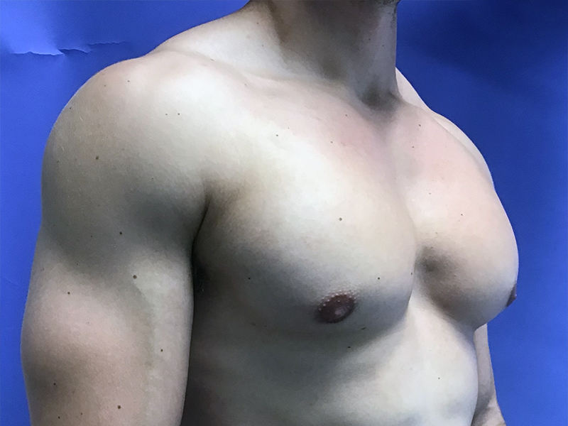 Male Breast Reduction Before and After | PERK Plastic Surgery
