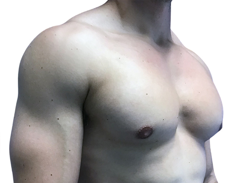 Male Breast Reduction Before and After | PERK Plastic Surgery