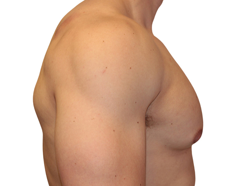 Male Breast Reduction Before and After | PERK Plastic Surgery