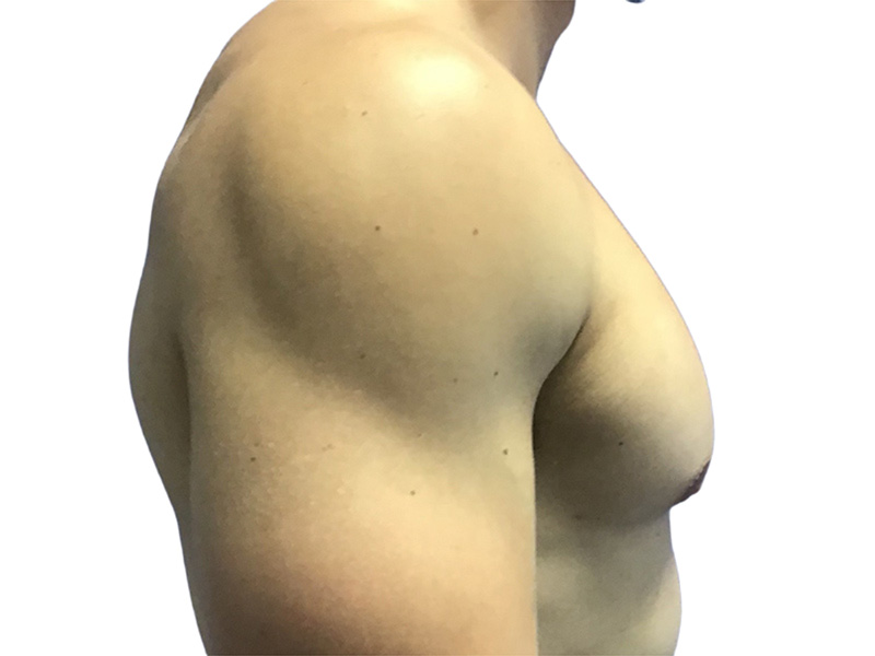 Male Breast Reduction Before and After | PERK Plastic Surgery