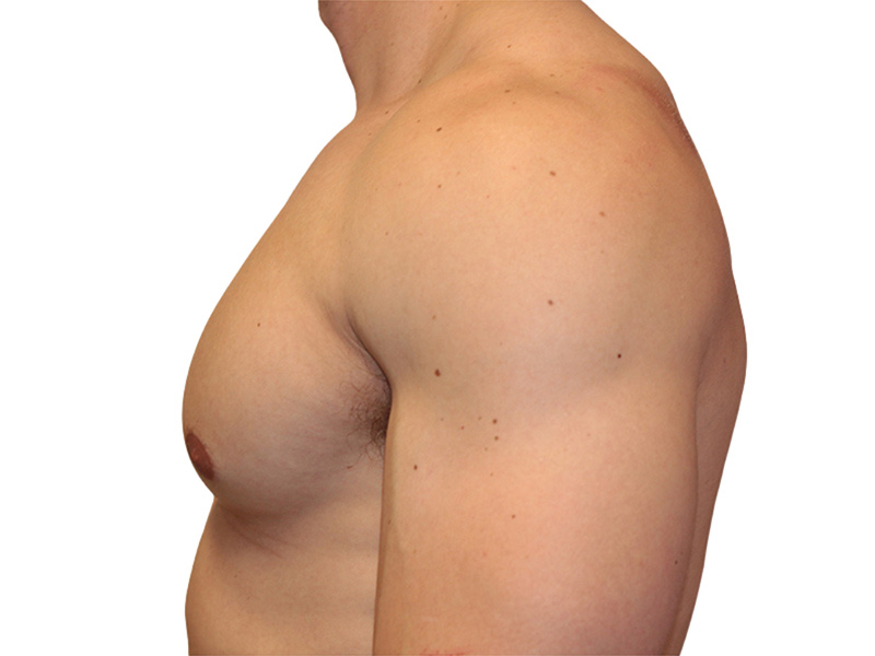 Male Breast Reduction Before and After | PERK Plastic Surgery