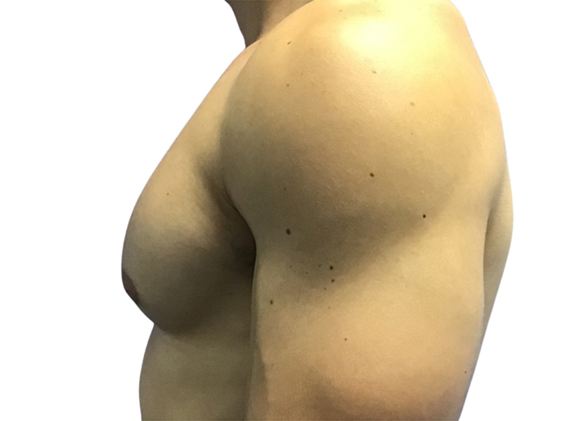 Male Breast Reduction Before and After | PERK Plastic Surgery