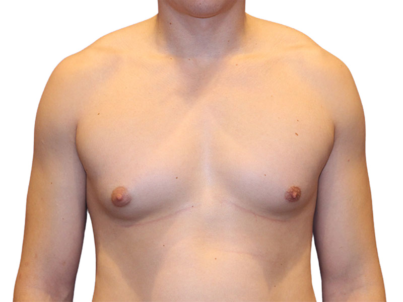Male Breast Reduction Before and After | PERK Plastic Surgery