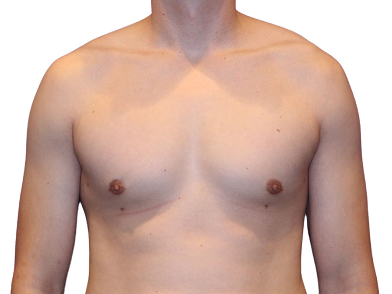 Male Breast Reduction Before and After | PERK Plastic Surgery