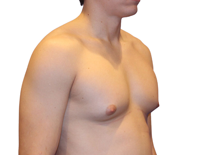 Male Breast Reduction Before and After | PERK Plastic Surgery